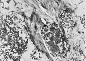 M,27y. | intracellular cholestasis - intoxication